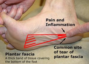 "Plantar