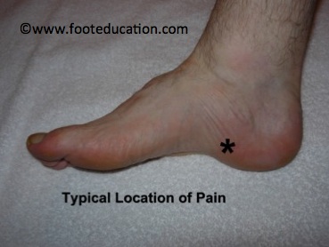 "Plantar