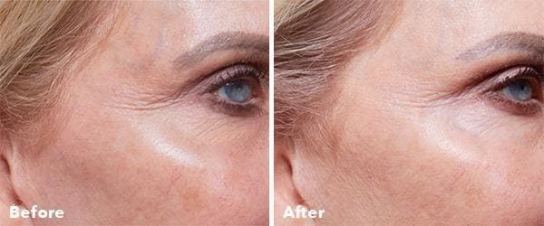 AnteAge Before & After Treatment