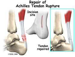 "Plantar