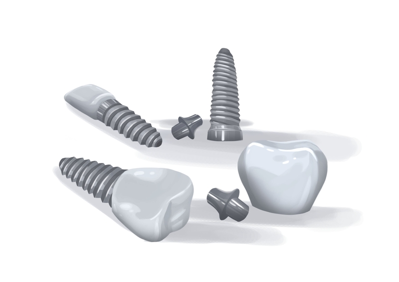 Mix of titanium dental implants