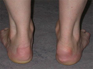 "Plantar