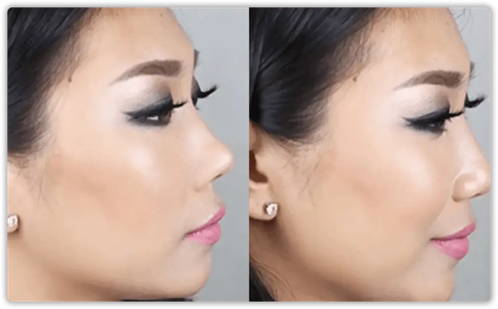Nose Job