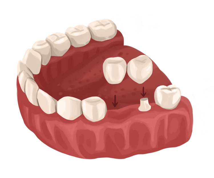 Dental Bridge Types And Procedure Authority Dental