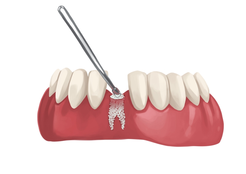 Dental bone graft procedure