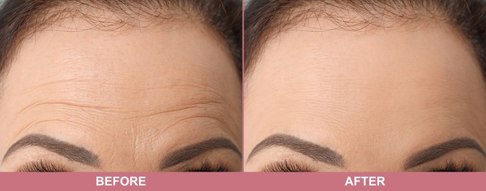 Top Treatment Options For Forehead Wrinkles In Vaughan Toronto Laser