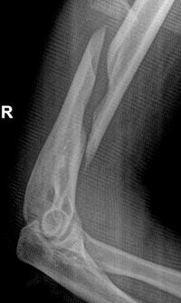 Humerus Fracture Repair in San Francisco by Dr. James Chen