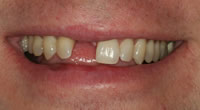 NewImplant2.jpg
