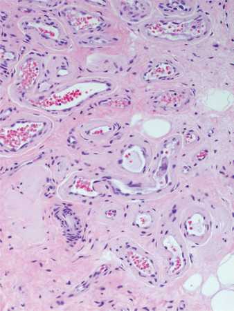 Hemangiom - cauze, simptome, tratament