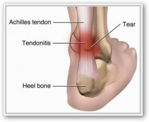 "Plantar