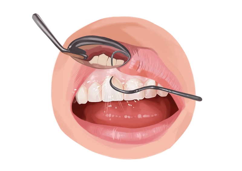 Deep dental cleaning procedure