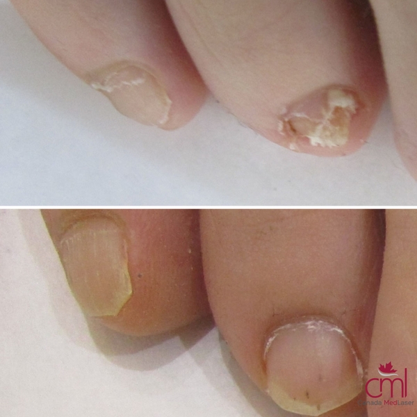 before-after-nail-fungus-3