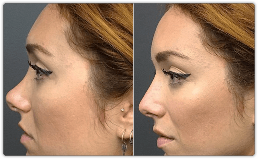 Non Surgical Nose Jobs In Mississauga Toronto Lip Doctor