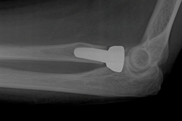 Elbow_fracture-Radial-Head-Post-1.jpg