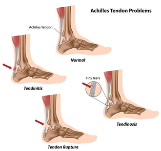 "Plantar