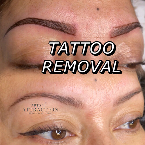 Tattoo Removal Training