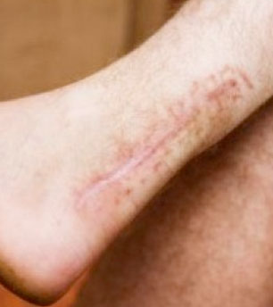 "Plantar