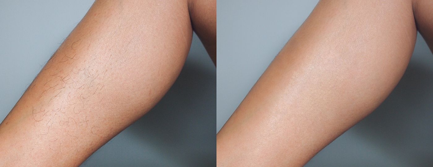brazilian laser hair removal in thornhill before after