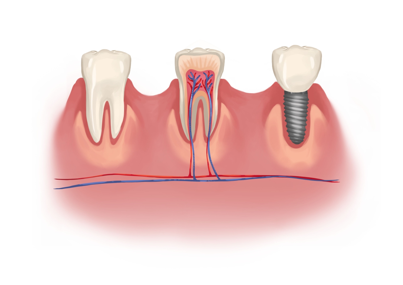 Do dental implants hurt? Tooth implants pain facts and tips