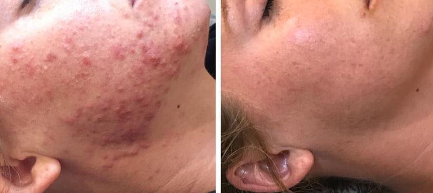 Before & After Cystic Acne Treatment