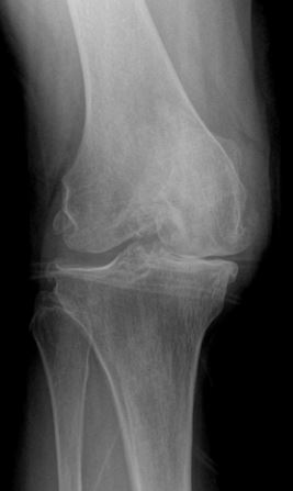 Knee_OA.JPG