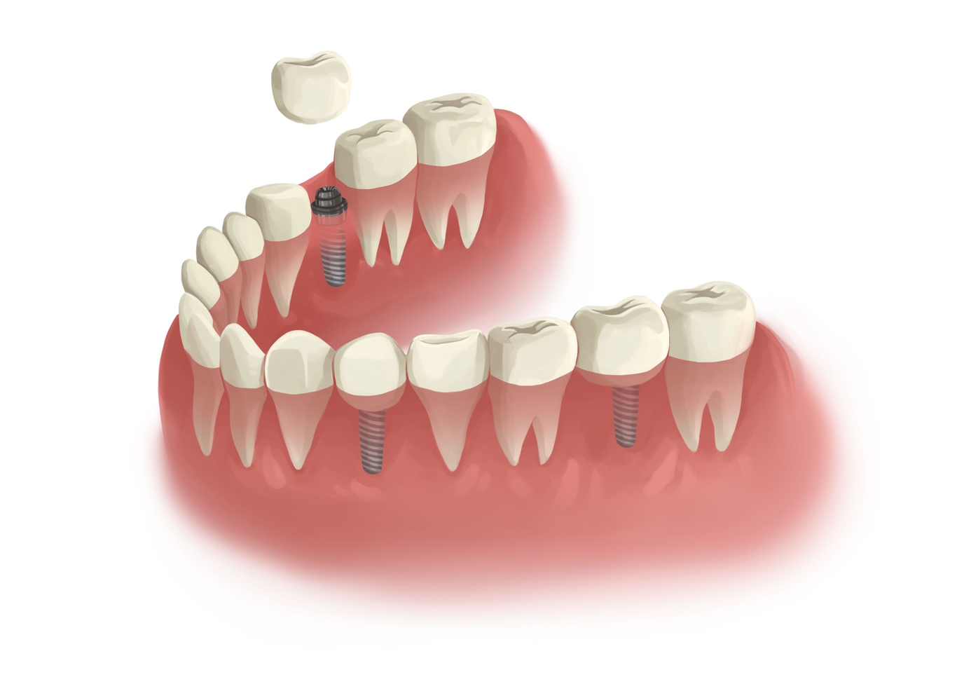 Dental implant recovery time span and symptoms