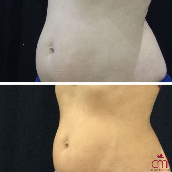 before-after-coolsculpting-2