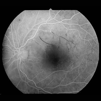 Emptied retinal venules due to arterial branch occlusion in diabetic retinopathy (fluorescein angiography). 10 June 1998. In Wikipedia. Retrieved from https://en.wikipedia.org/wiki/Diabetic_retinopathy#/media/File:Retinal_branch_occlusion_ratkaj.jpg under CC BY-SA 4.0 license.