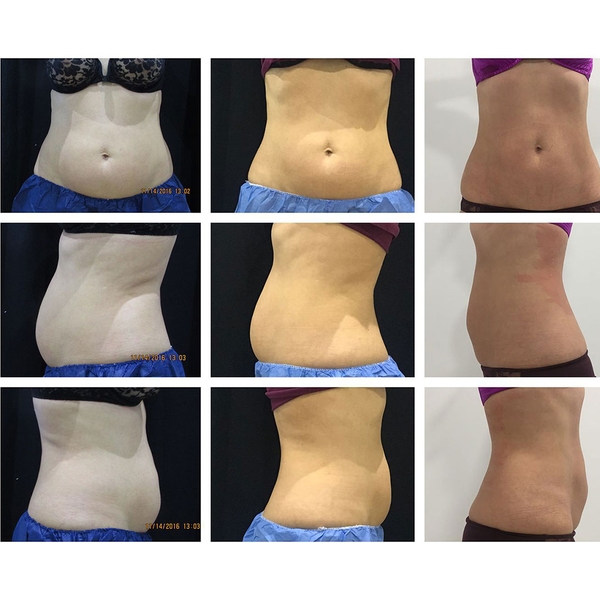 before-after-coolsculpting-1