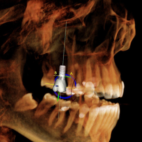 Perforation du sinus par un implant dentaire