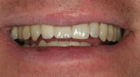 NewImplant3.jpg