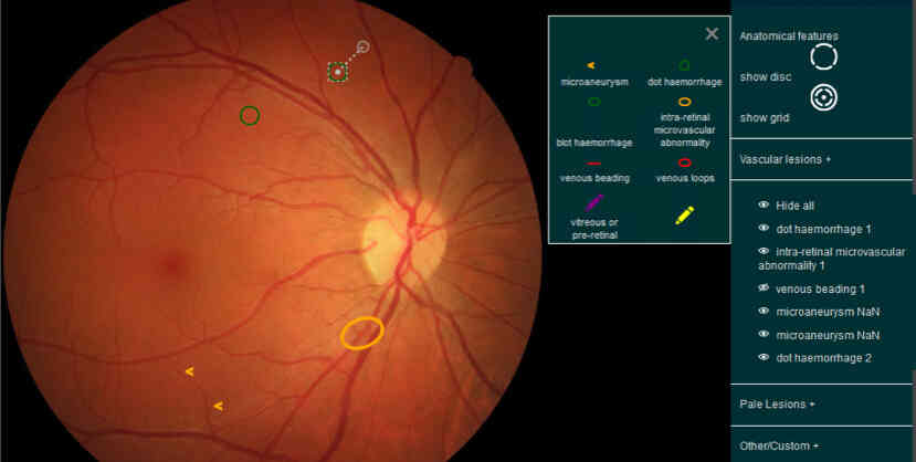 A screenshot of the CREDIS - Fundus lesion annotation tool