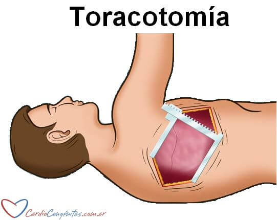 Toracotomia