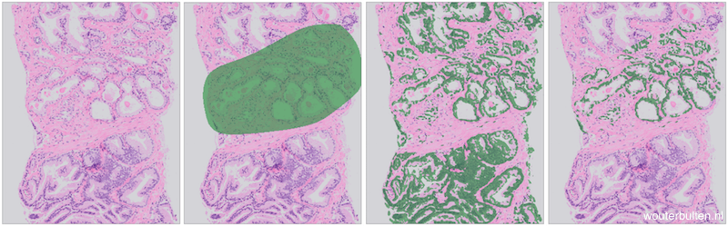 Example prostate tissue with PCa (extracted from a core needle biopsy) (1), tumor annotations (2), epithelium segmentation (3), segmentation and annotations combined (4). 