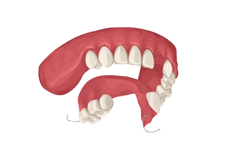 Upper partial dentures
