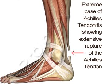 "Plantar