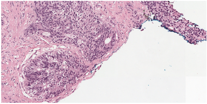 Gleason 4/5 area from a prostate biopsy