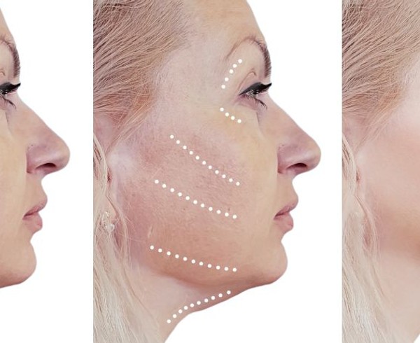 non-surgical facelifts