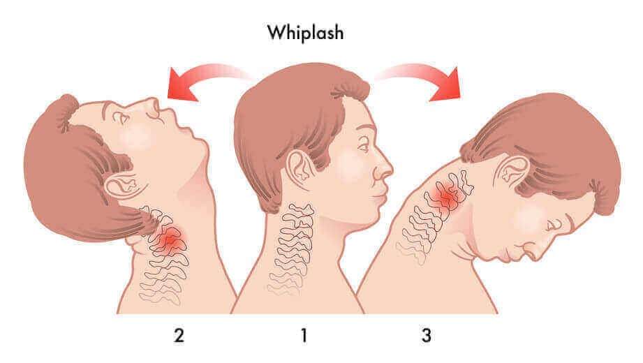 Los Angeles Whiplash Accident Lawyers