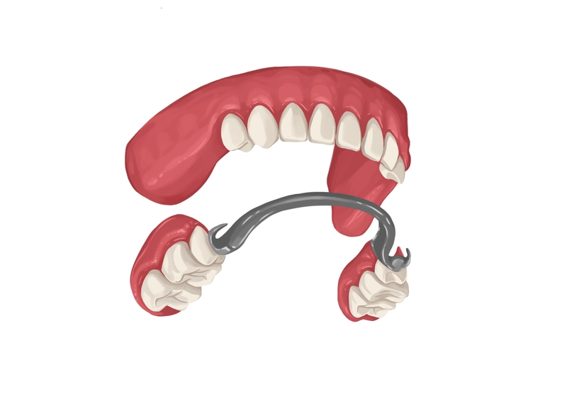 Metal partial dentures for upper arch