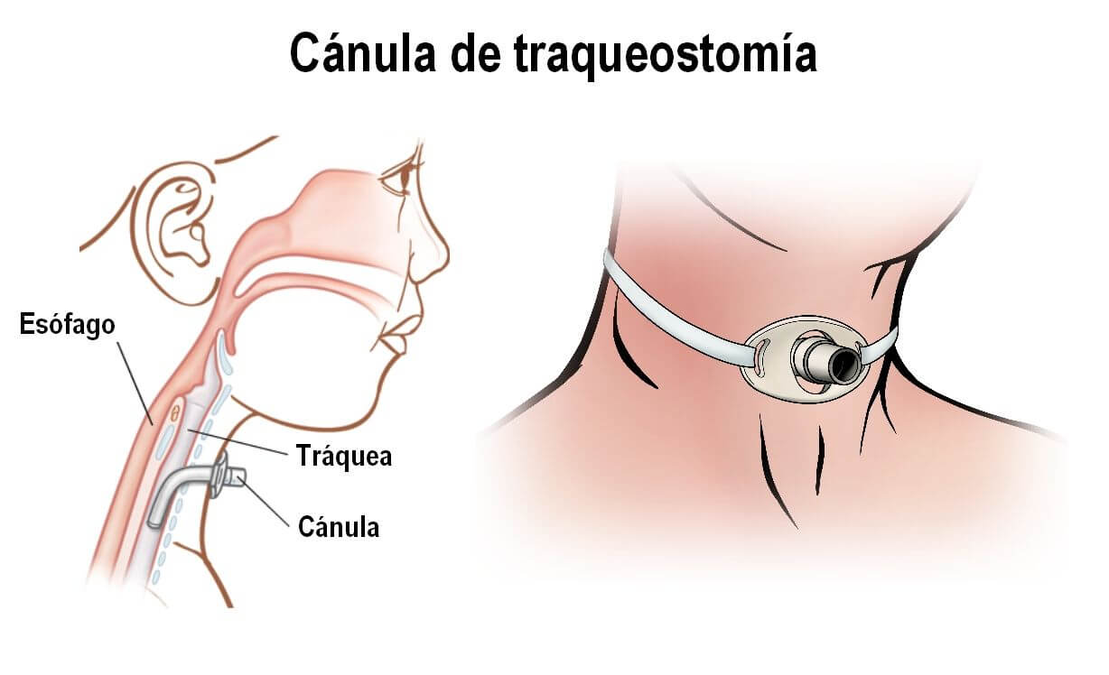 Traqueostomia