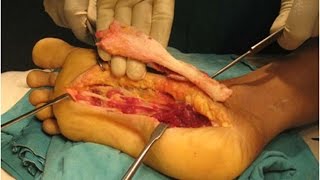"Plantar
