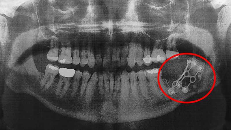 An x-ray of Gravity's jawbone