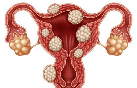 Fibrom Uterin | Embolizare, beneficii și riscuri |