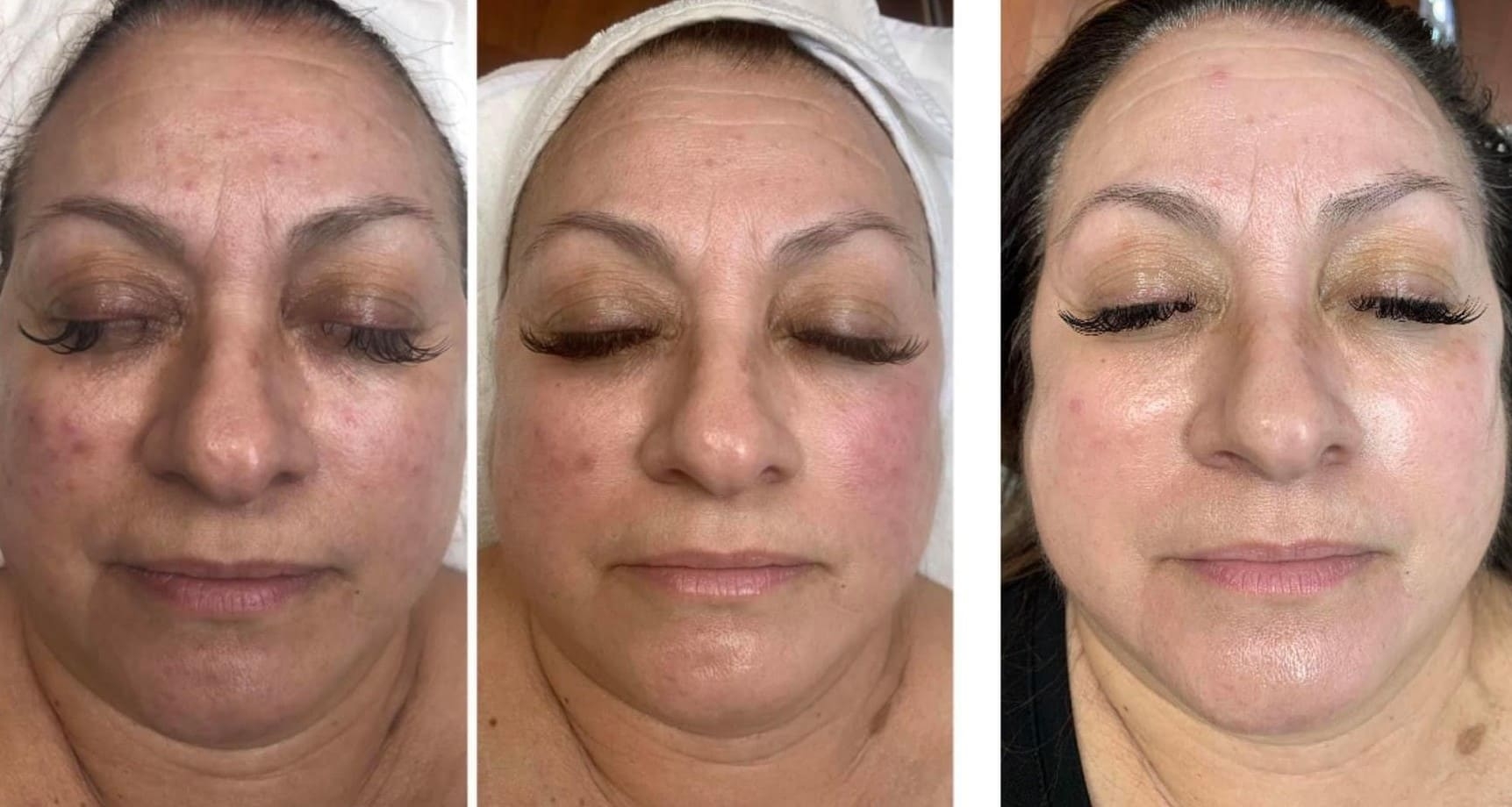 AfterGlow Peel Before & After Treatment
