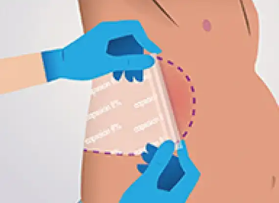 illustration of specialist removing QUTENZA patch from torso