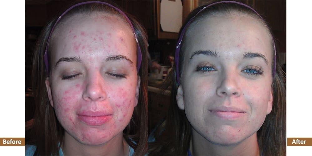 Holistic Acne Program Before & After Treatment Image