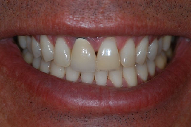 Before