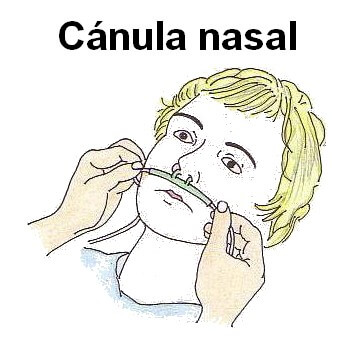 Canula-nasal