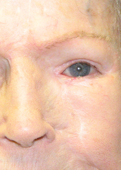 mohs-face-after.jpg